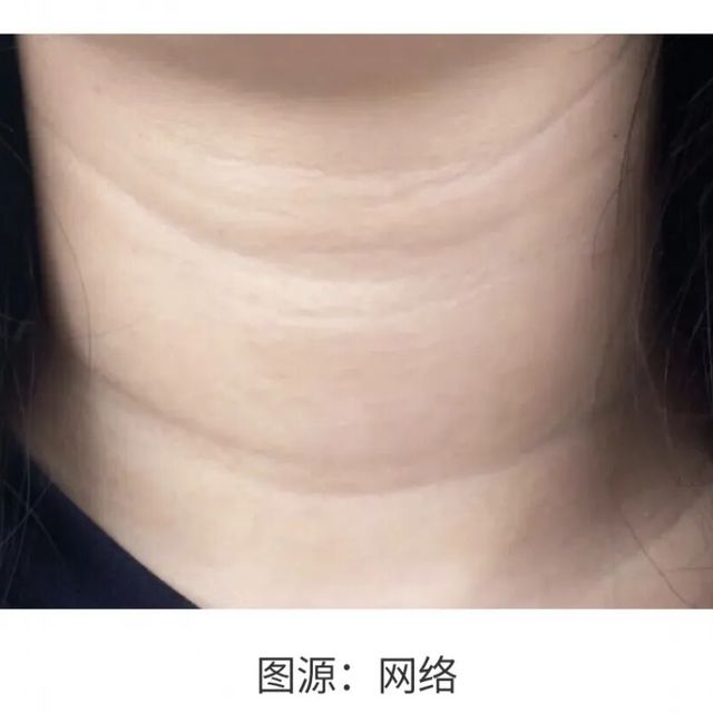 全球首款颈纹III型胶原填充剂获批，医美新材料赛道正式开卷