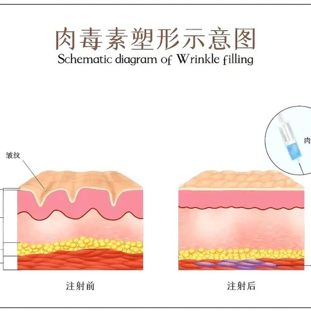 瘦肩瘦腿针全揭秘：有效成分是毒素？3分钟自测你到底适不适合