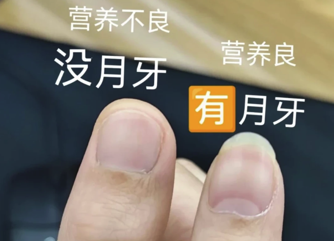 手上没有月牙,就是体虚?别被指甲传言骗了