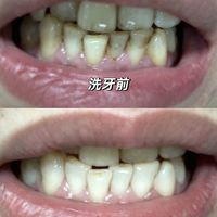 9.9元团购洗牙，结账300+：把5个加项全拆明白，哪个该接受、哪个直接拒绝