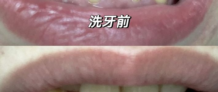 9.9元团购洗牙，结账300+：把5个加项全拆明白，哪个该接受、哪个直接拒绝