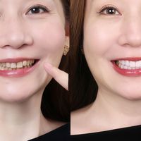 一口灰黄牙毁掉的不只是笑容：瓷贴面能救，但先看完这篇