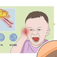 重庆中耳炎就诊参考:儿童中耳炎影响听力和语言发育