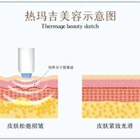 想做热玛吉？先看完这篇别被坑了