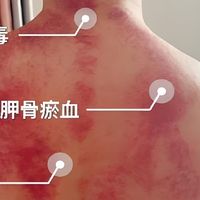 厚朴手记学习古法第五天：刮痧刮错了地方