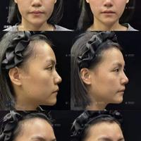 每3个打玻尿酸的人就有1个鼻子变宽,避开这3个坑能救命