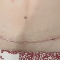 刨腹产去疤痕用哪款祛疤膏，聊聊产后刀口修护踩过的坑