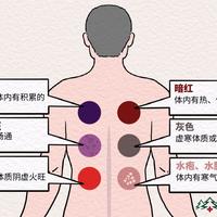拔罐印越深，毒素越多？先搞清楚背上那圈印子，再决定办不办卡