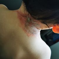 隐翅虫的危害