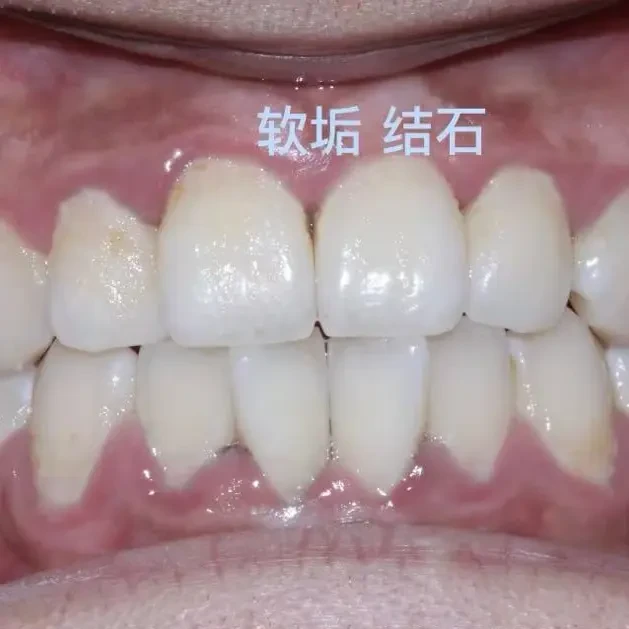 洗牙有的地方30块，有的地方400多，评论区还吵成两派：我翻完全网近半年的真实账单和辟谣帖，理清去哪洗、医保怎么用上、哪些坑要避开