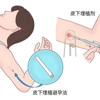 "避孕药"其实是三种完全不同的药：短效每天吃、紧急只补救、长效能避就避——下单前先对表
