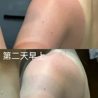 晒伤后马上拍冰块、敷美白面膜？对完三平台50多篇帖子和新华网医生提醒：3个最常见的"第一反应"其实在帮倒忙