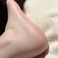 穿了一夏洞洞鞋，脚后跟磨成"铁皮"、涂身体乳没用：买足膜前，先回答这层皮是茧还是真菌