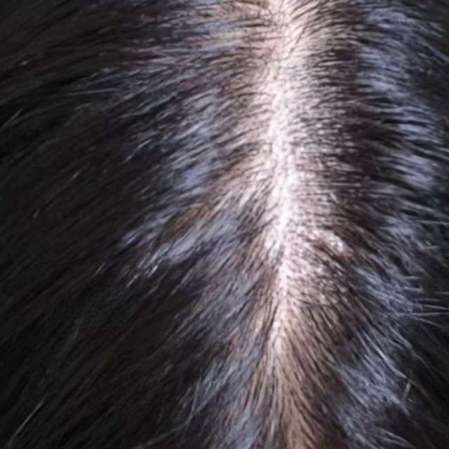 女生头顶越来越稀疏？脂溢性脱发护理篇