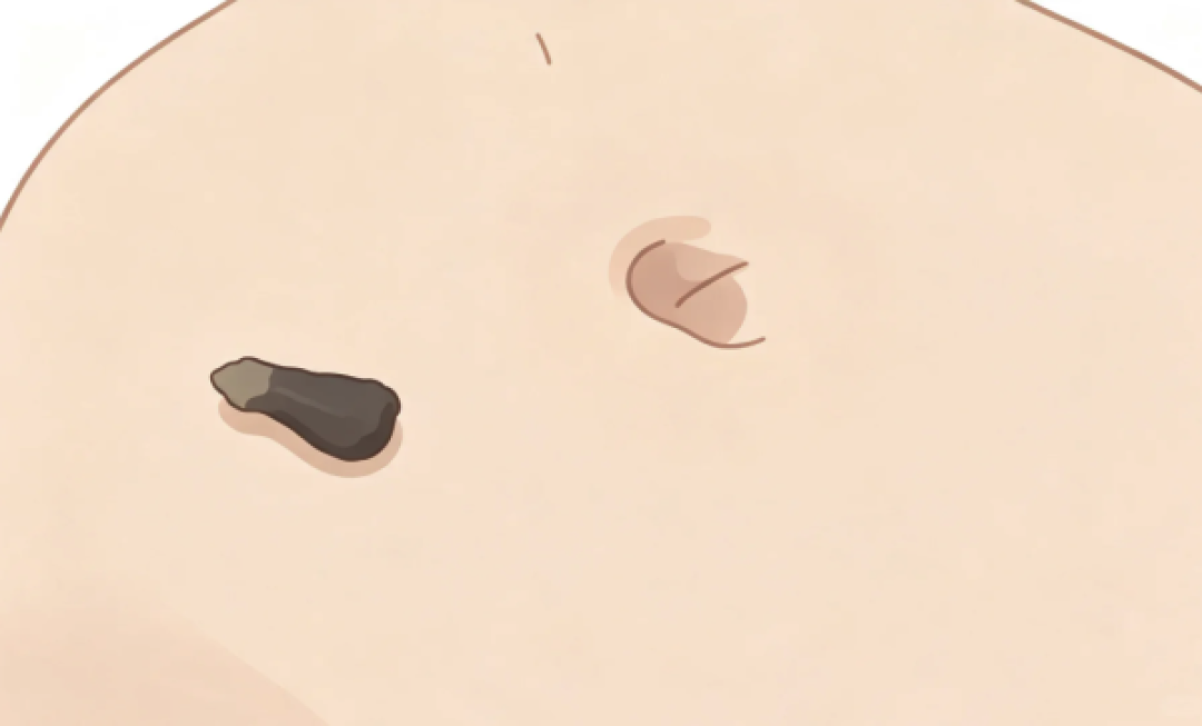 肚脐眼里的泥到底是什么？现在到底能不能扣？用这几样即可