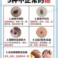 5种不正常的痣,当心是黑色素瘤!