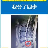 腰突保守成功，我经历了四步！