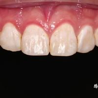 晚间刷牙与无痛牙病 | 口腔保健8.31日报