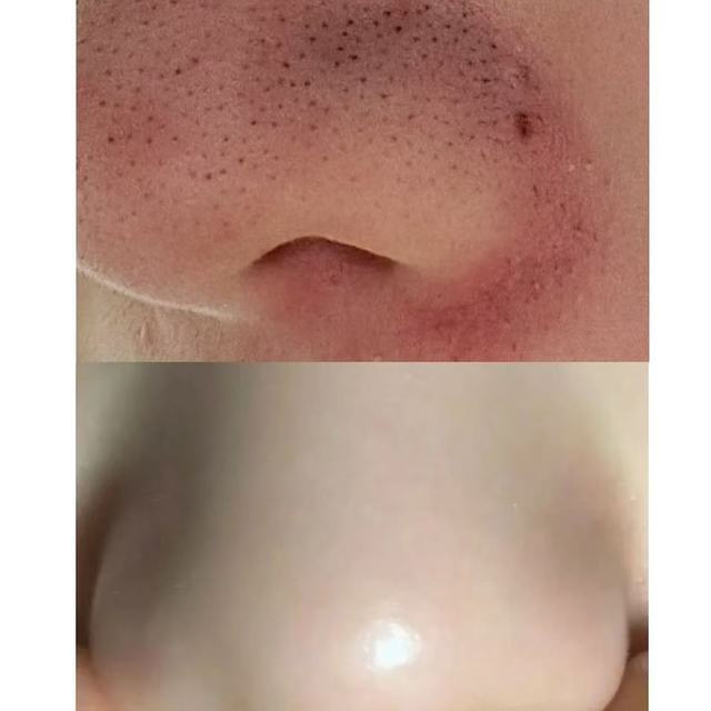 试了十几种去黑头的方法，真正有效果的只有这一个