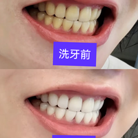 一口黄牙被洗白后，这个方法不“复发”