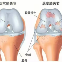 氨糖卖到16.8元一瓶，先别急着囤：胃、血糖、在吃的药，这三关比价格重要