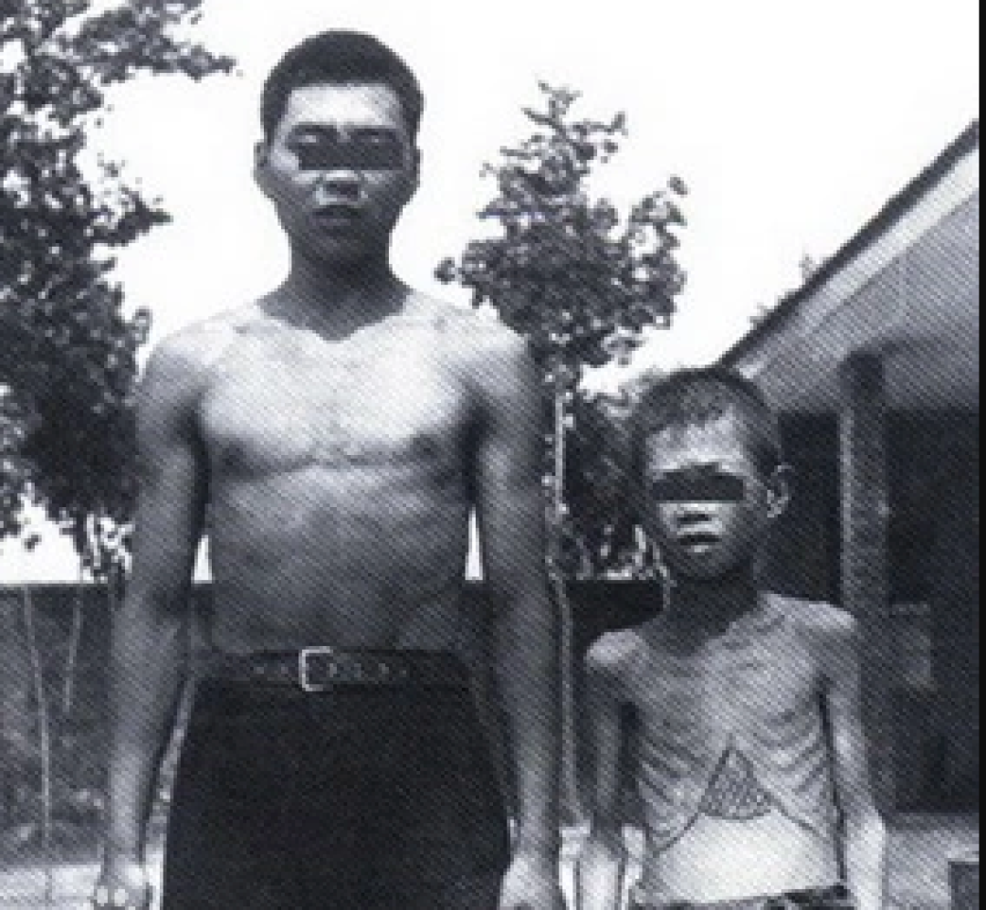 右侧男孩为受华枝睾吸虫感染者