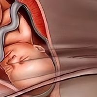产妇急产生下女儿，5分钟后发现还藏有一个！孕期B超真的不能省