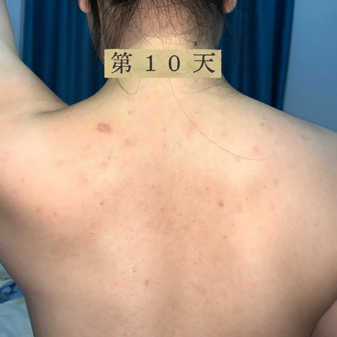 后背“痘”用遍祛痘产品都不见好?多半不是痤疮:先对4项自测,再决定30元洗剂花不花