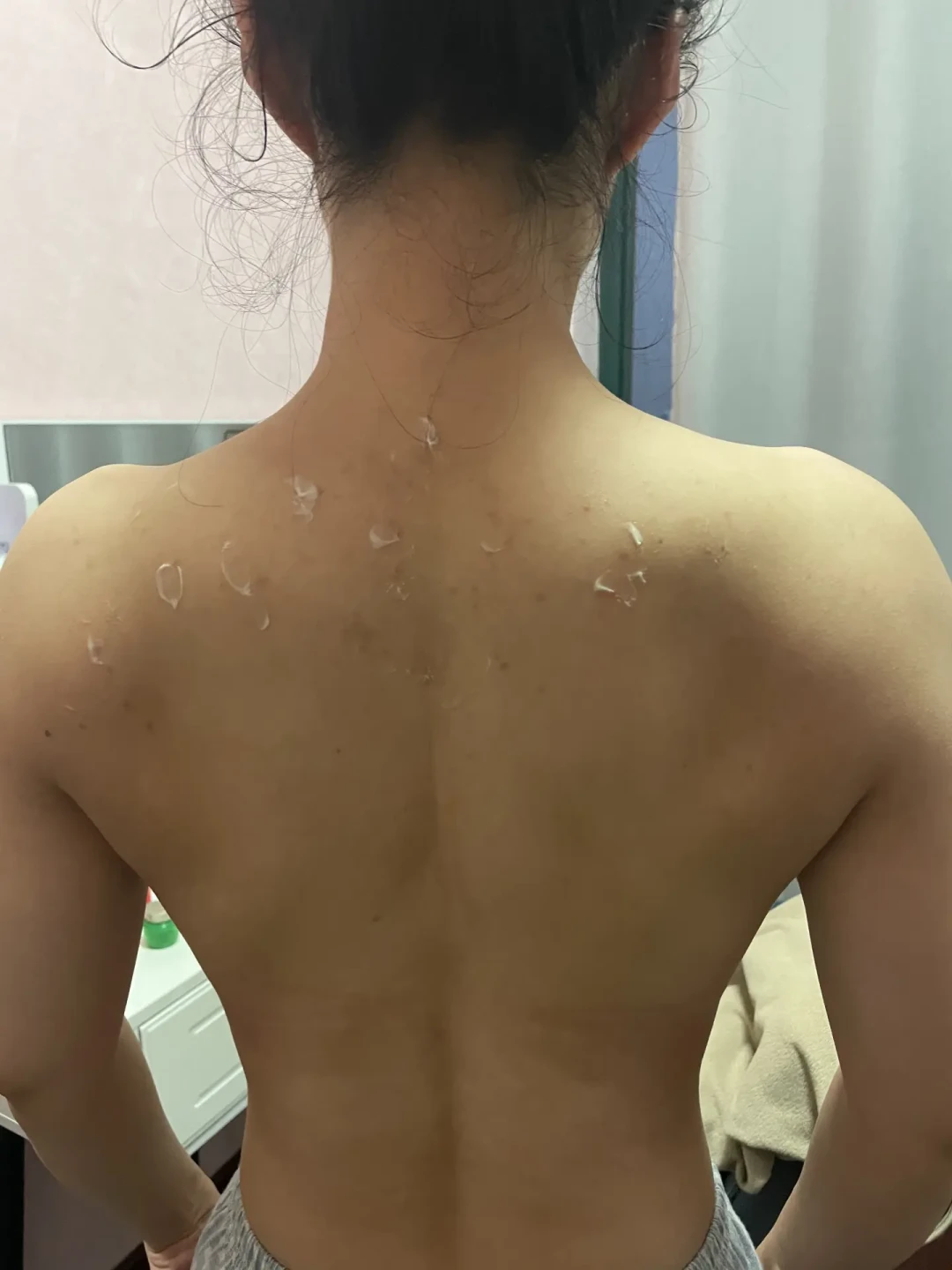 后背“痘”用遍祛痘产品都不见好?多半不是痤疮:先对4项自测,再决定30元洗剂花不花