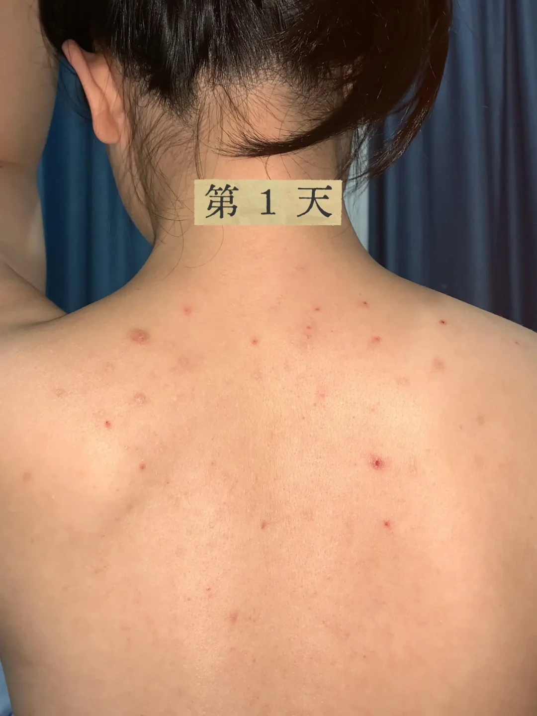 后背“痘”用遍祛痘产品都不见好?多半不是痤疮:先对4项自测,再决定30元洗剂花不花