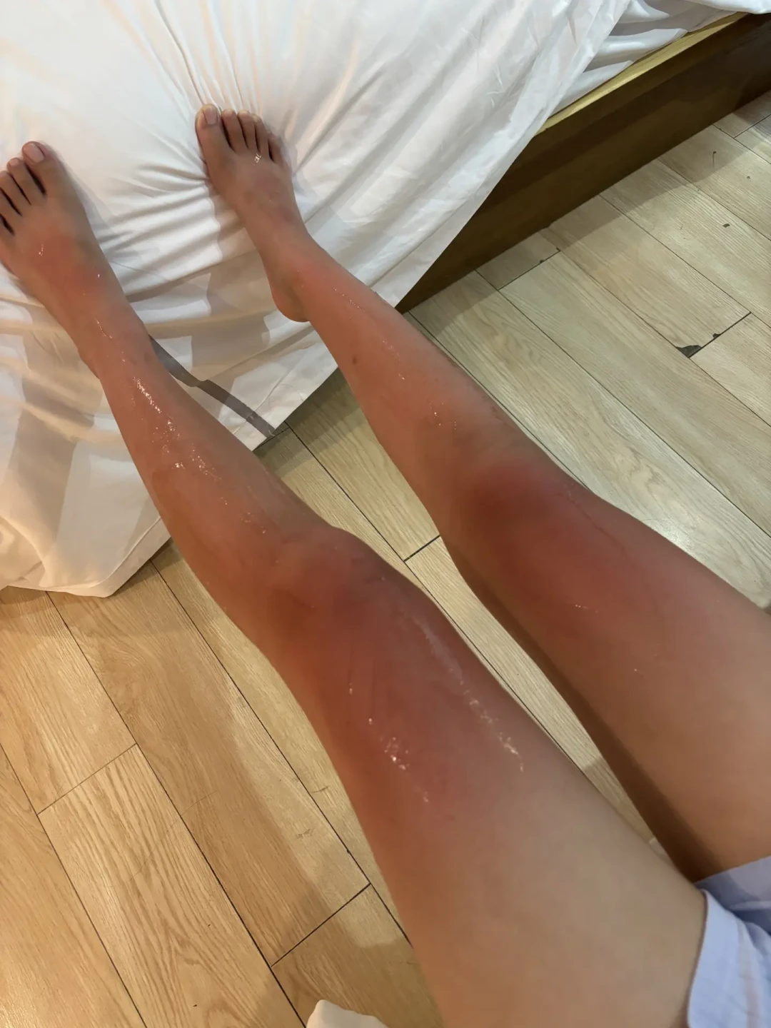 晒伤之后,冰敷、偏方、立刻美白?前72小时最容易做错的3件事,和真正该花的钱