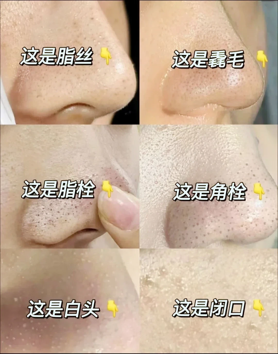 黑头反复长、毛孔越折腾越大:我把三个平台的