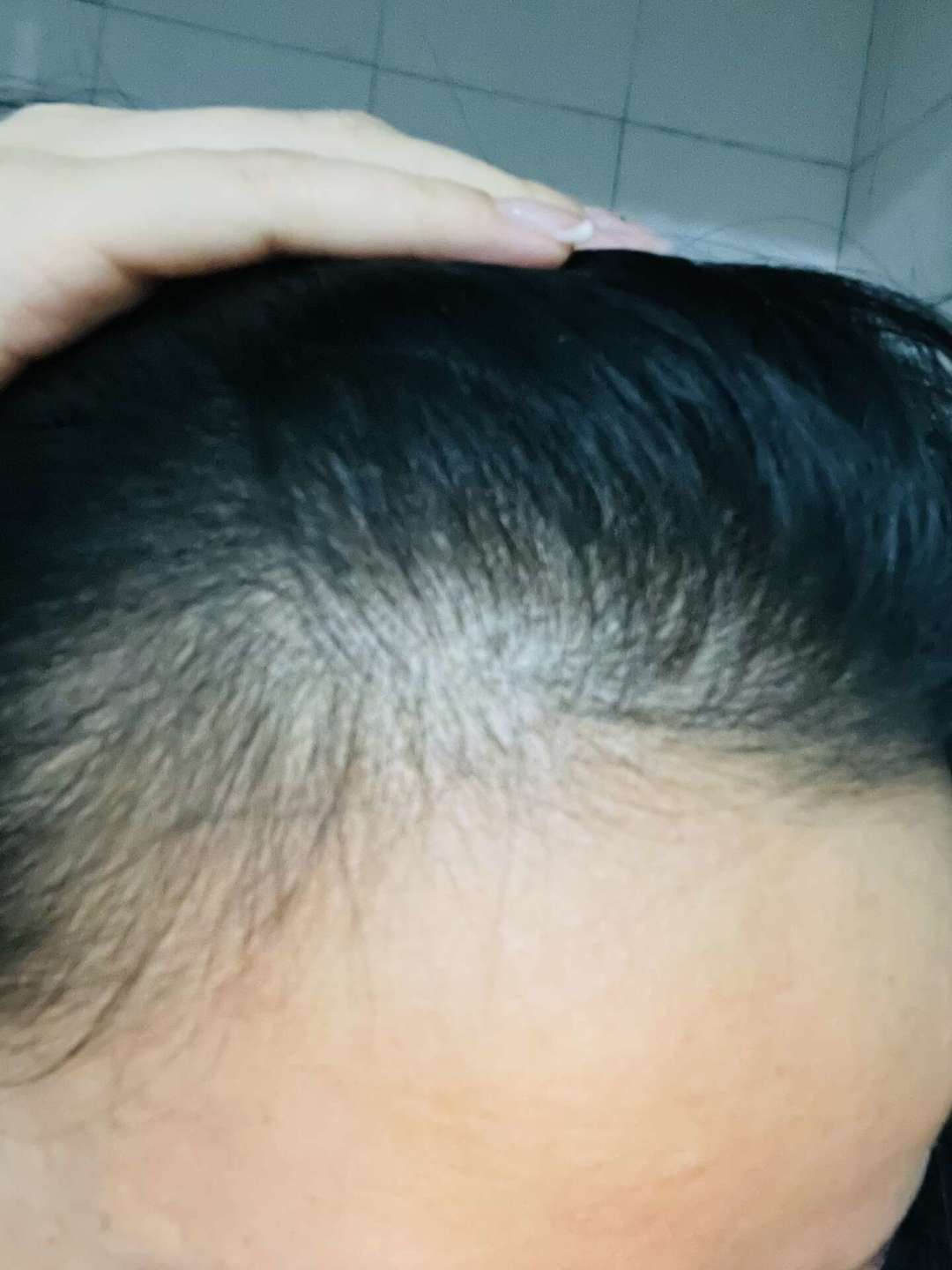 减肥三个月后头发一把把掉?这种脱发大多能自己长回来,先别急着买这4类产品