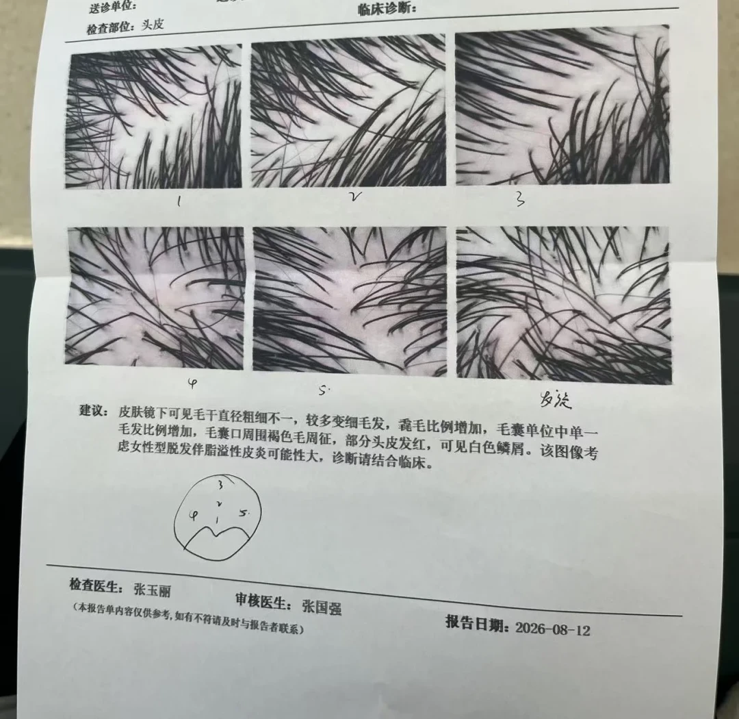 有人花1400，有人不到300：脱发去医院检查的钱该怎么花，顺序和避坑清单都整理好了