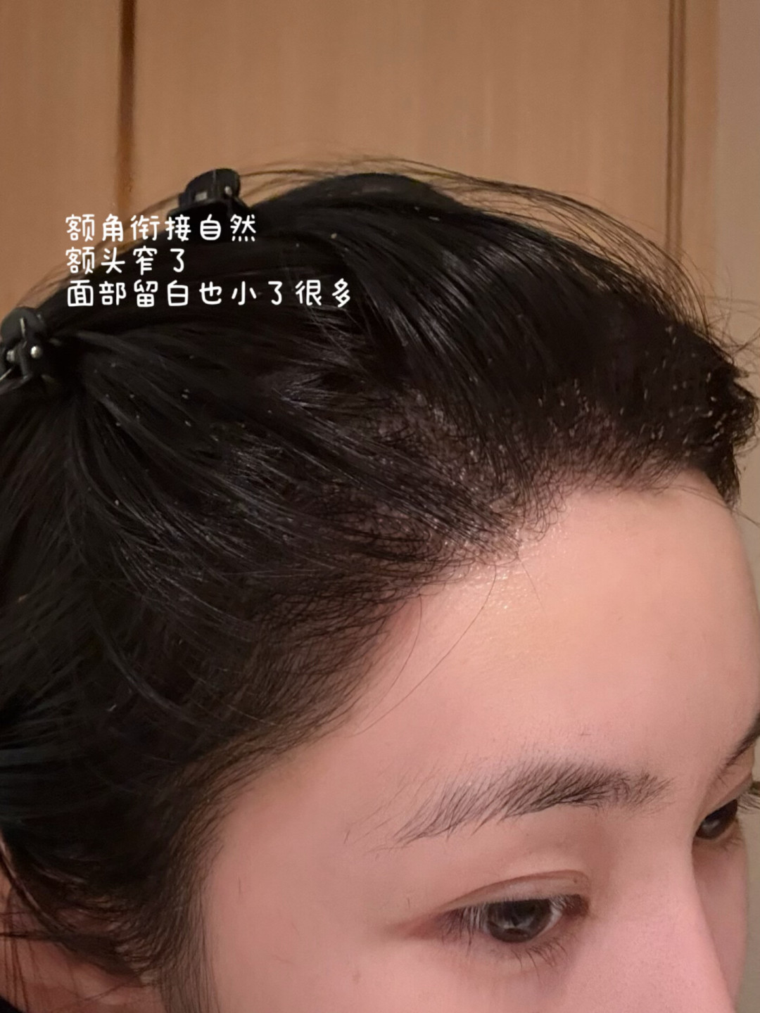 植发前先把这笔账算明白:手术费只是首付,后面还有一笔“月供”