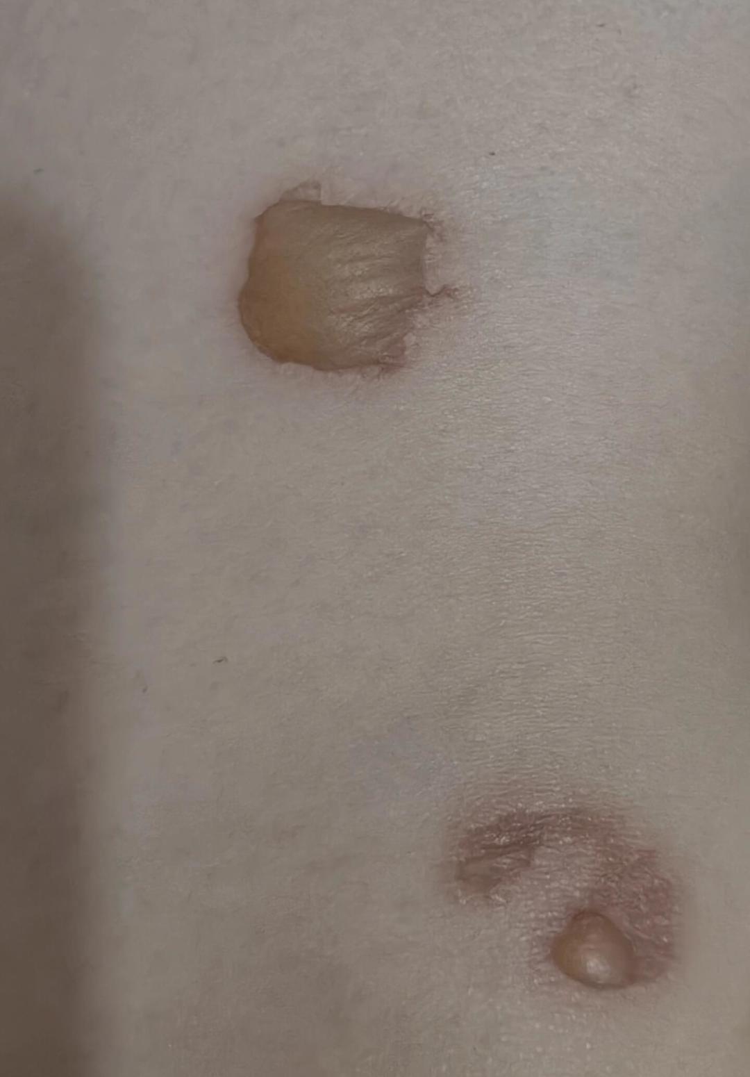 出伏倒计时5天,把今年的三伏贴盘一遍:起泡是不是