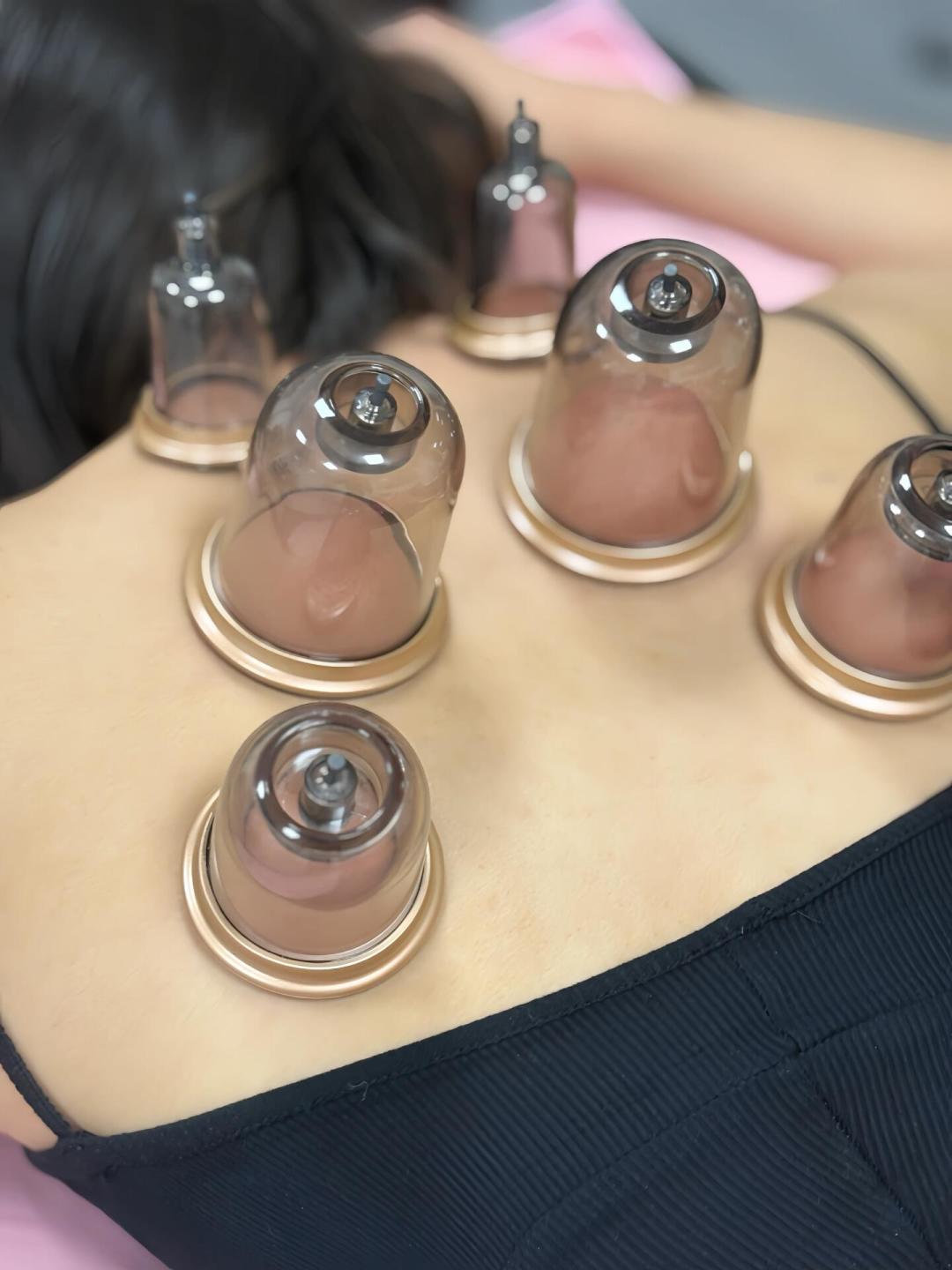 拔罐烧伤、技师失联、酒店甩锅:武汉研三女生已起诉,这份到店拔罐避坑和维权清单请收好