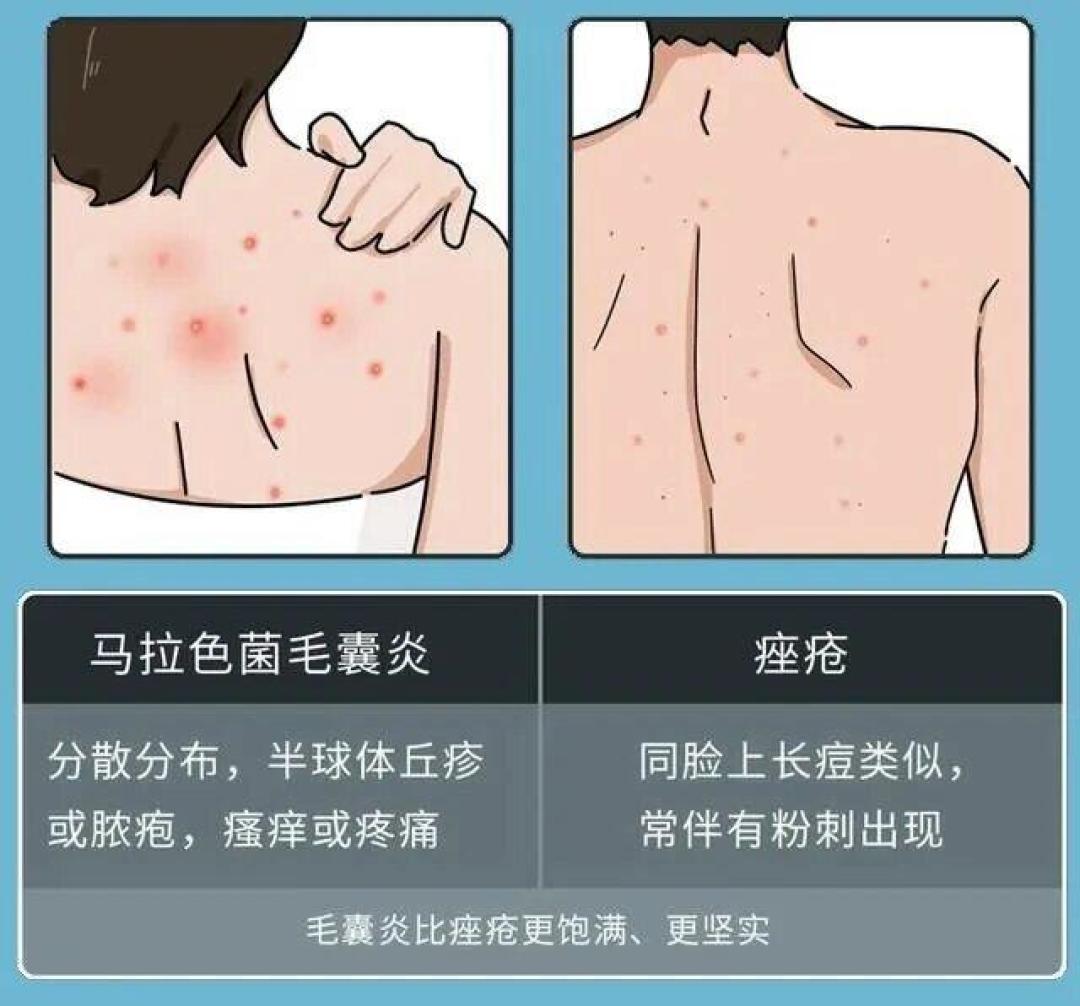 后背的疙瘩可能不是痘:1867条评论没认出来,我对完三平台热帖,4条对症路线都是几十块档