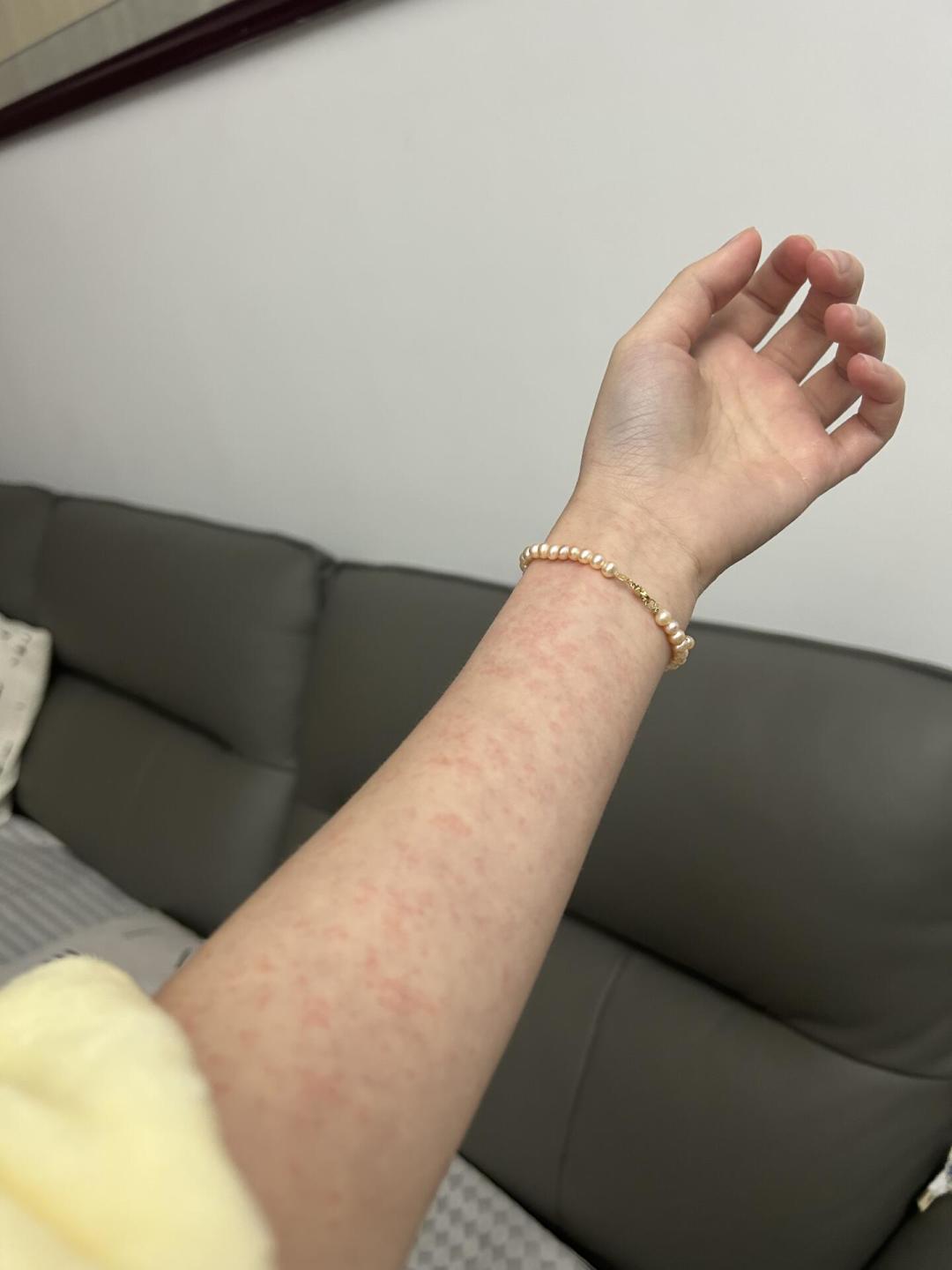 都是花蚊子传的,登革热和基孔肯雅热怎么区分?一篇讲清症状差异、危险期和就医检测
