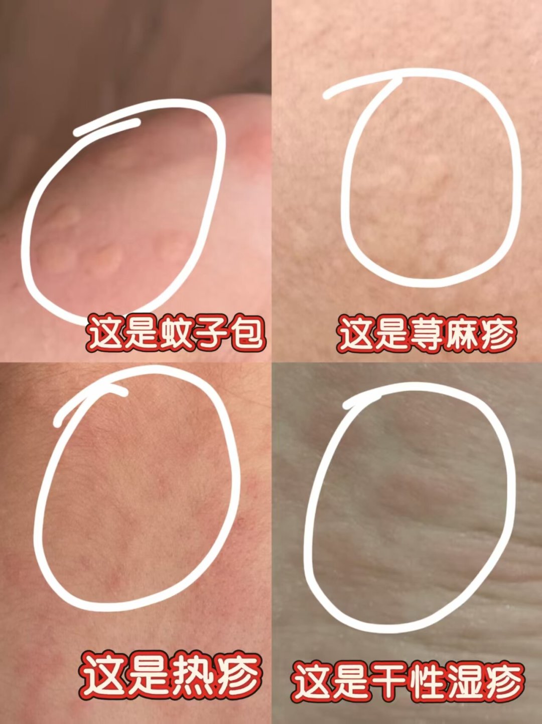 爽身粉越扑,娃的痱子越重?热门祛痱产品口碑对比+循证流程,8月祛痱不花冤枉钱