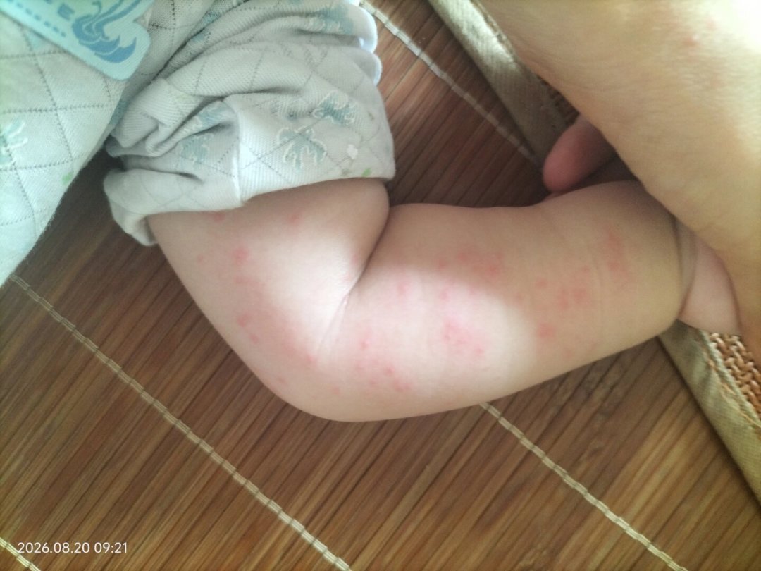 爽身粉越扑,娃的痱子越重?热门祛痱产品口碑对比+循证流程,8月祛痱不花冤枉钱