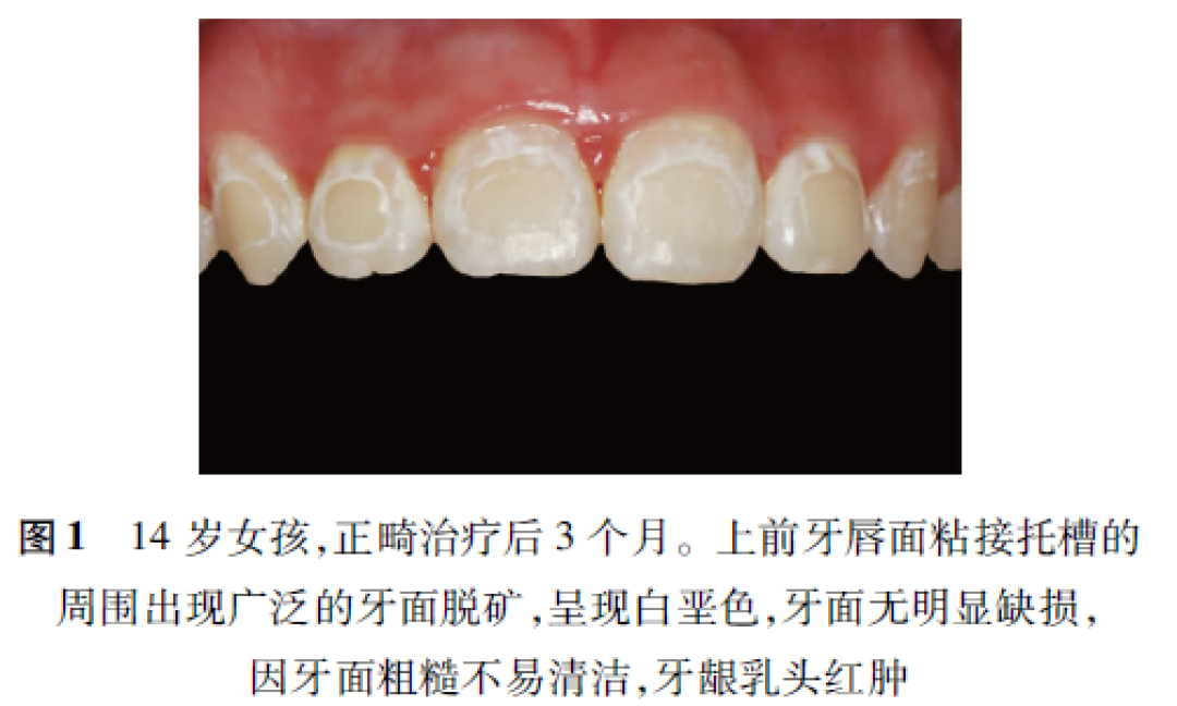 16款奥拉氟牙膏只有1款是真的?正畸防蛀,别为「正畸专用」交智商税