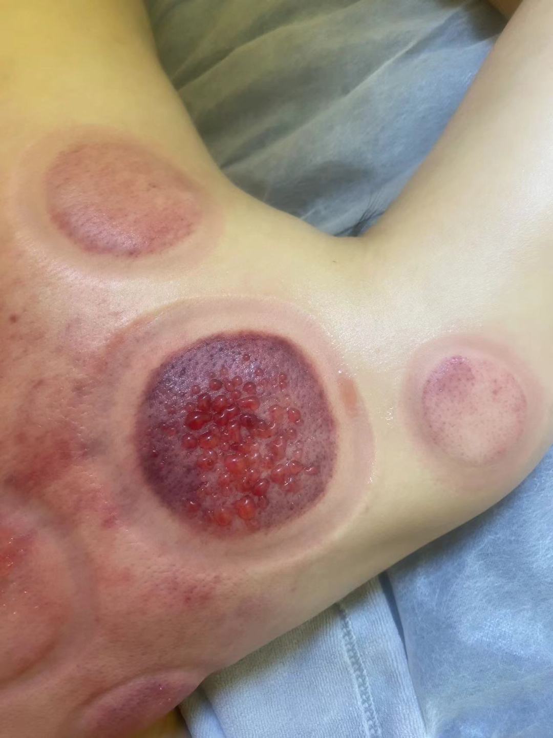 出伏倒计时4天,三伏拔罐