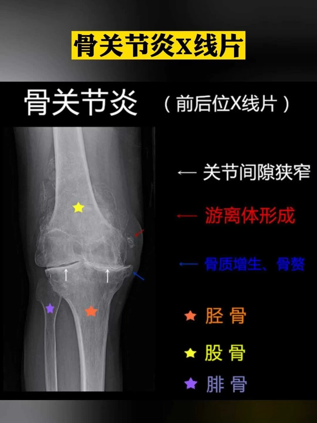 氨糖不是智商税,但很多人买错了:翻完各大机构的立场,我整理出三个问题自查