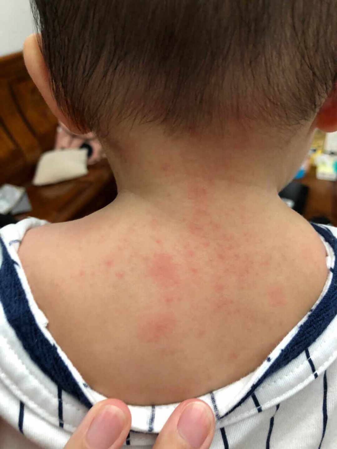 宝宝夏天起疹子，多数是热疹却被当湿疹治：抹的方向完全相反，抹错会越抹越重