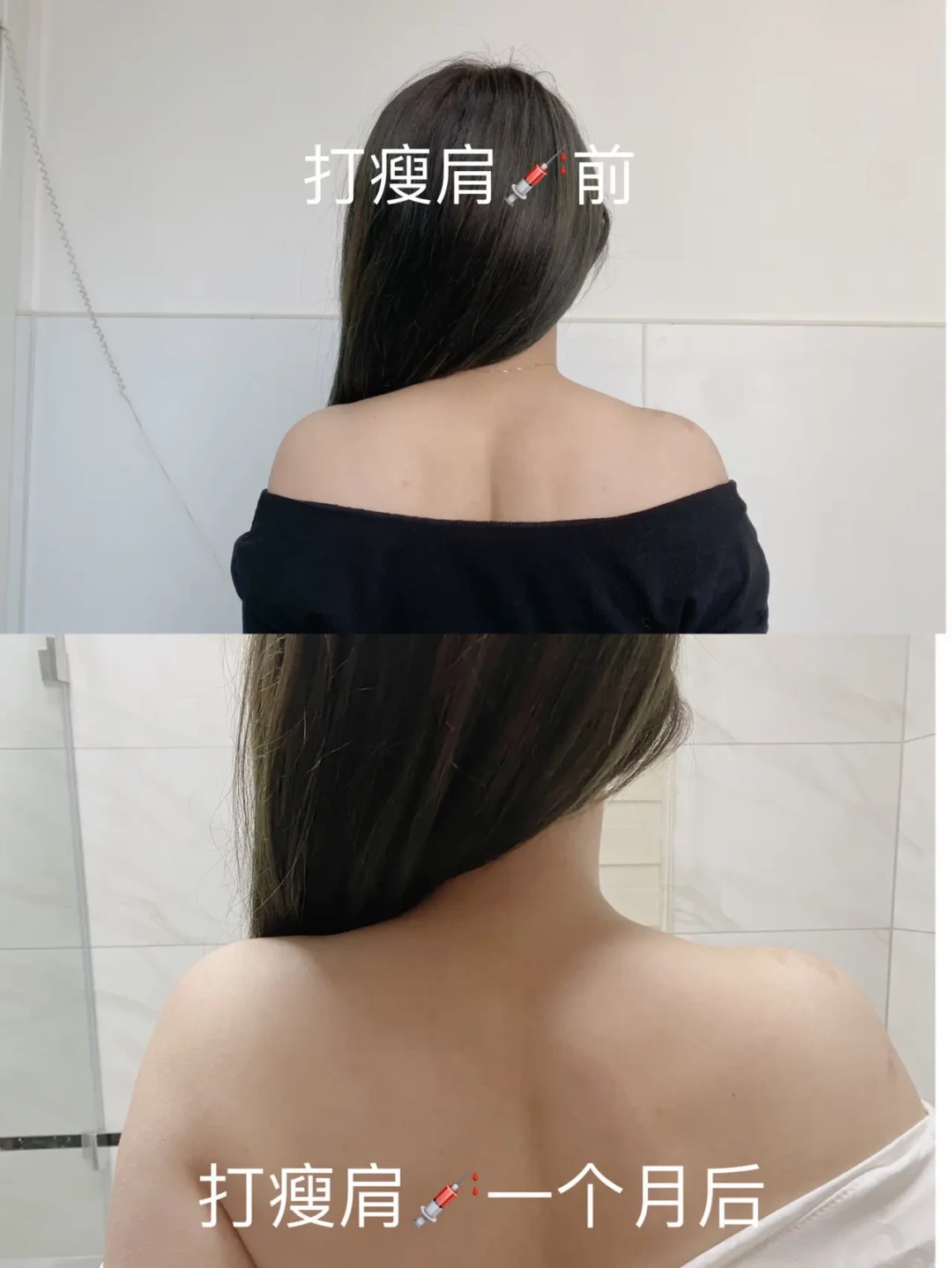 瘦肩针的种草帖和后悔帖，高峰期是同一拨：刷完小红书热门帖，建议你先搞清3件事