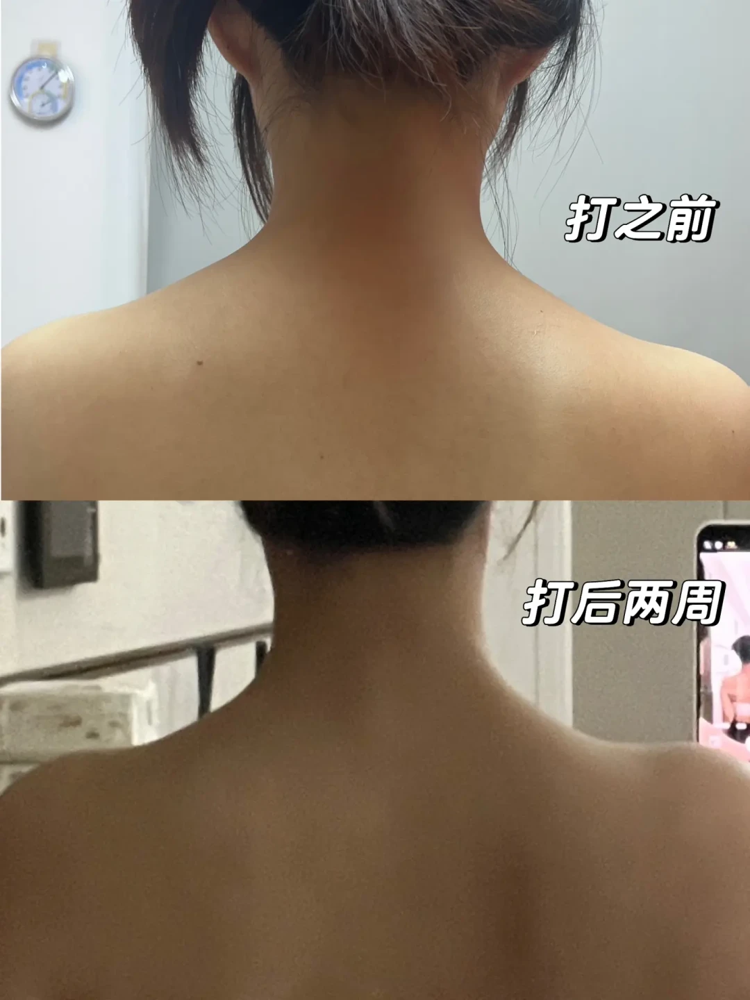 瘦肩针的种草帖和后悔帖，高峰期是同一拨：刷完小红书热门帖，建议你先搞清3件事