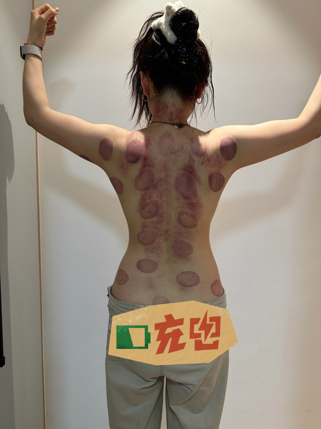 拔罐烧伤、技师失联、酒店甩锅:武汉研三女生已起诉,这份到店拔罐避坑和维权清单请收好