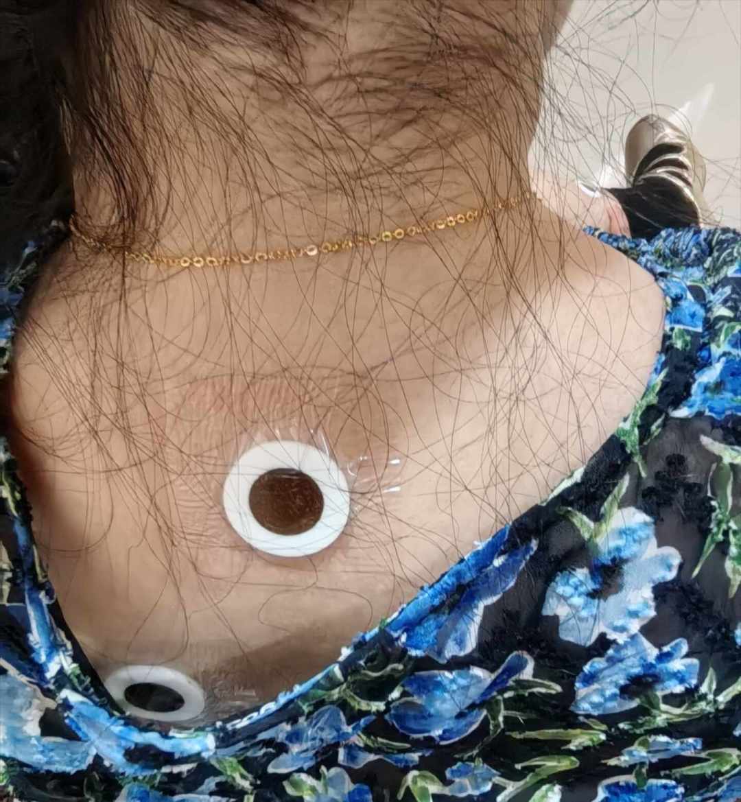 出伏只剩2天，三伏贴还没贴？先分清自己是“寒”还是“热”，再决定花不花这笔钱