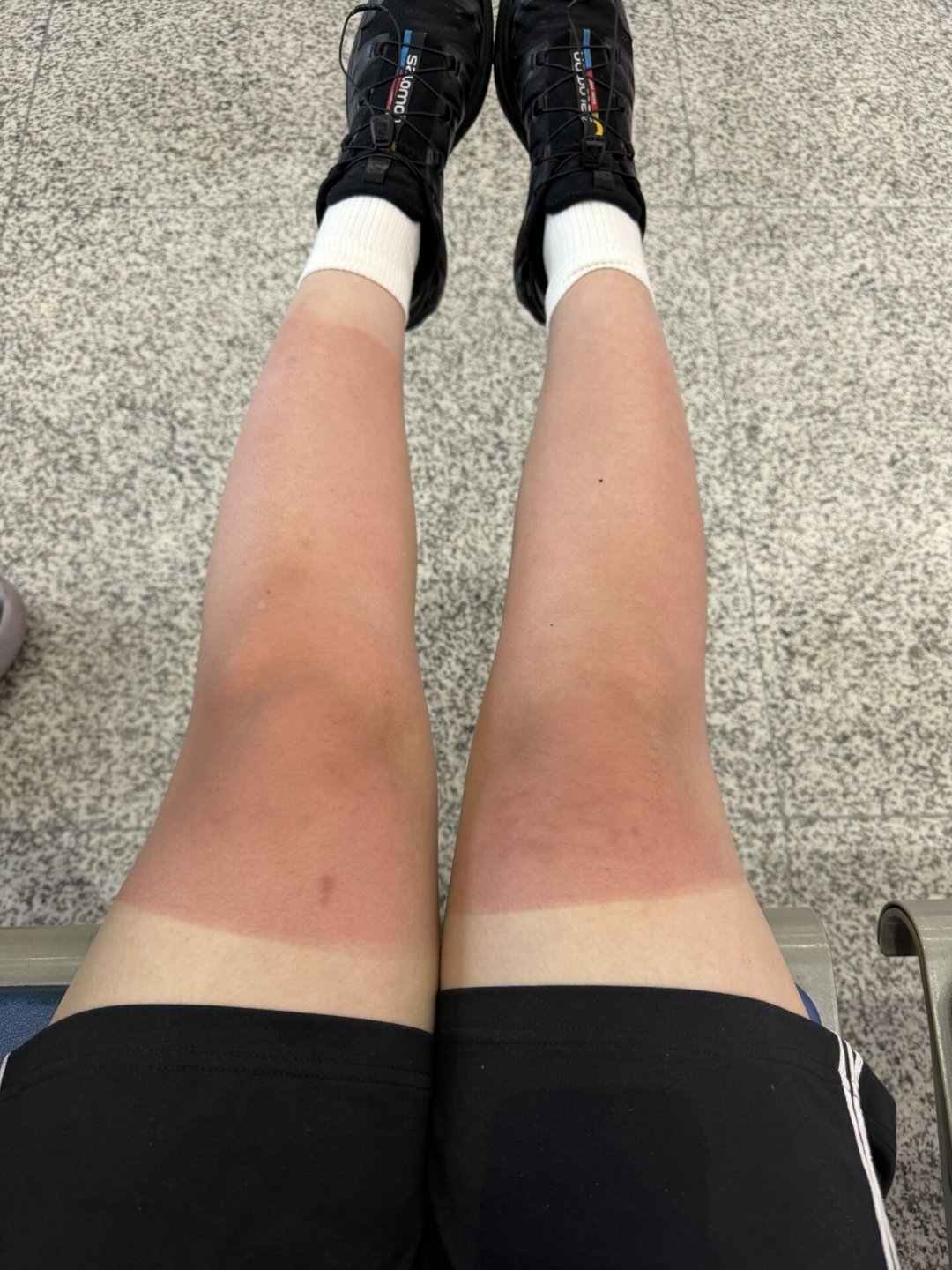 「顶多就是晒黑」？男子玩桨板3小时，晒到坐轮椅：夏季玩水的防晒账，别算错了